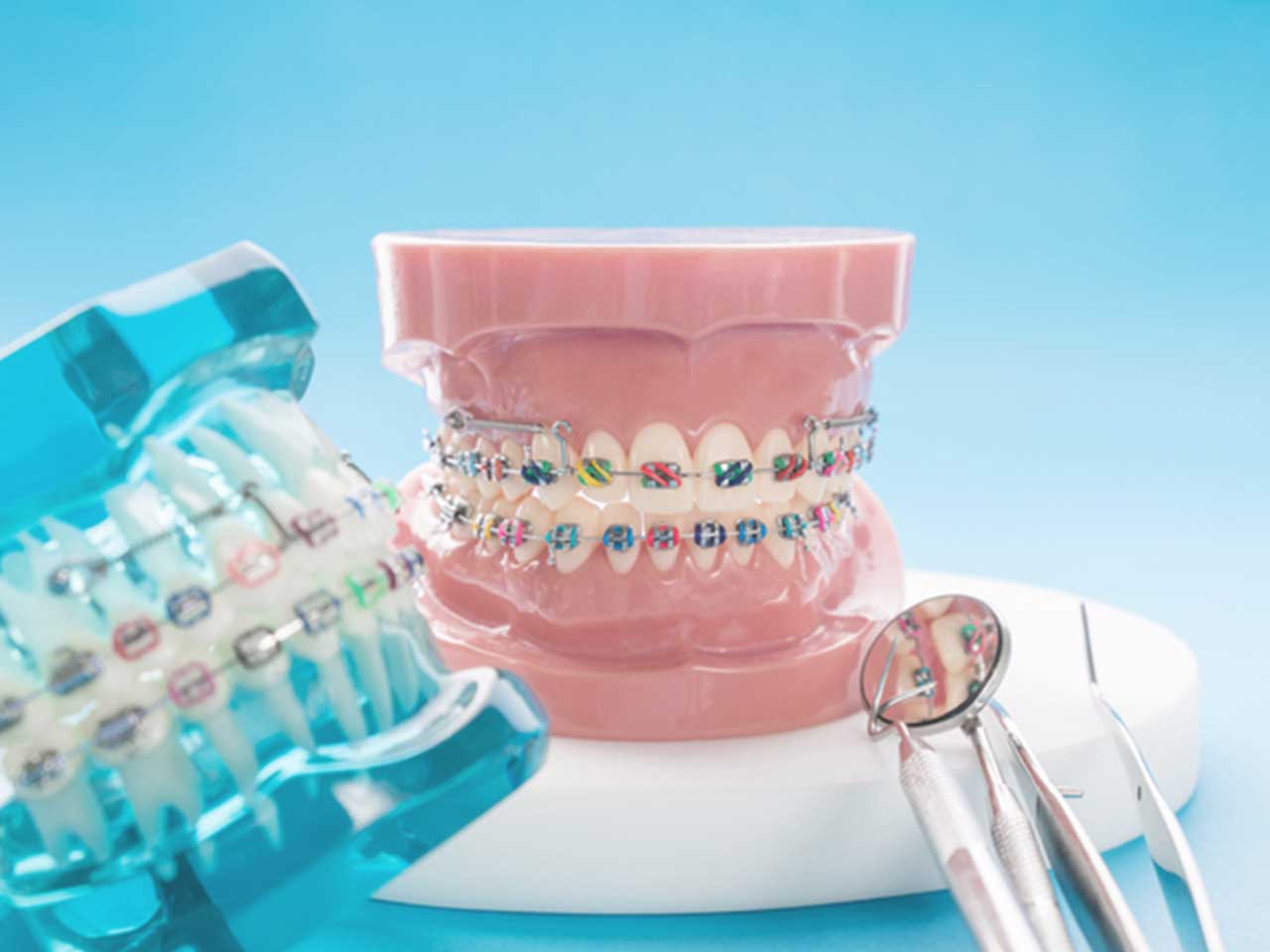 models of teeth with orthodontic braces and bands
