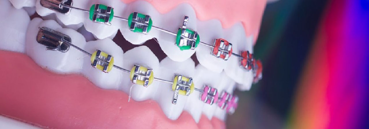 Close up of colorful orthodontic bands on mouth model