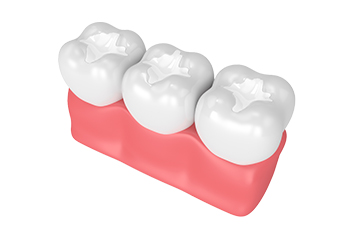 model of three teeth with sealant materials