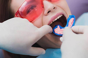 gloved hands inserting tray in child mouth fluoride treatment