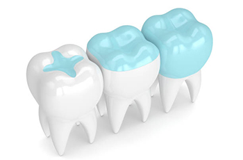 model of three teeth