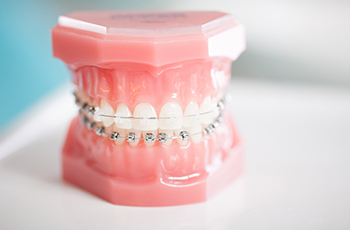 mouth model with braces orthodontic bands