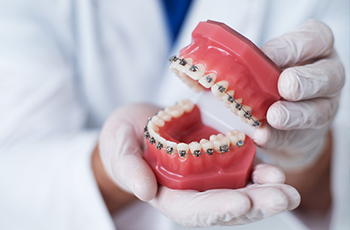 gloved hands holding mouth model with orthodontic braces